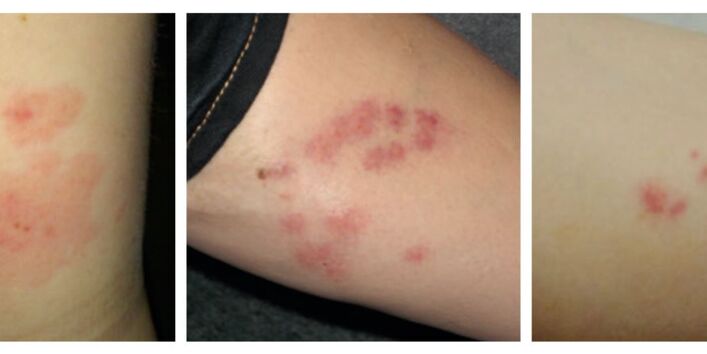 Drei Beispiele für Bettwanzenstiche beim Menschen