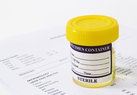 verschlossener, beschrifteter Becher mit einer Urinprobe steht auf einem Laborbericht
