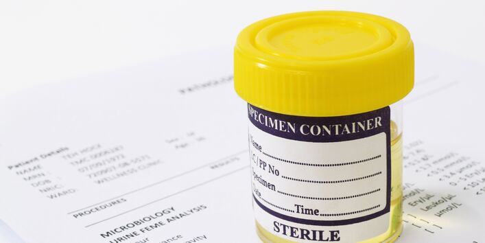 verschlossener, beschrifteter Becher mit einer Urinprobe steht auf einem Laborbericht
