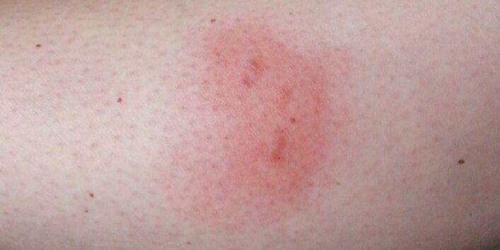 mehrere rote Stiche am Arm einer Person